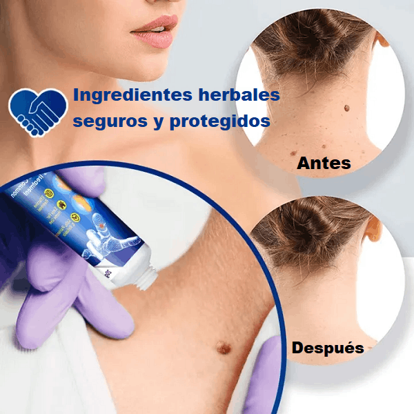 Crema WART CARE™ - REMOVEDOR DE VERRUGAS